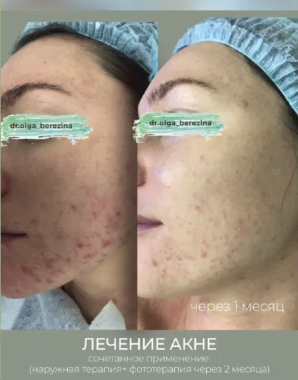 Как лечить акне эффективно?